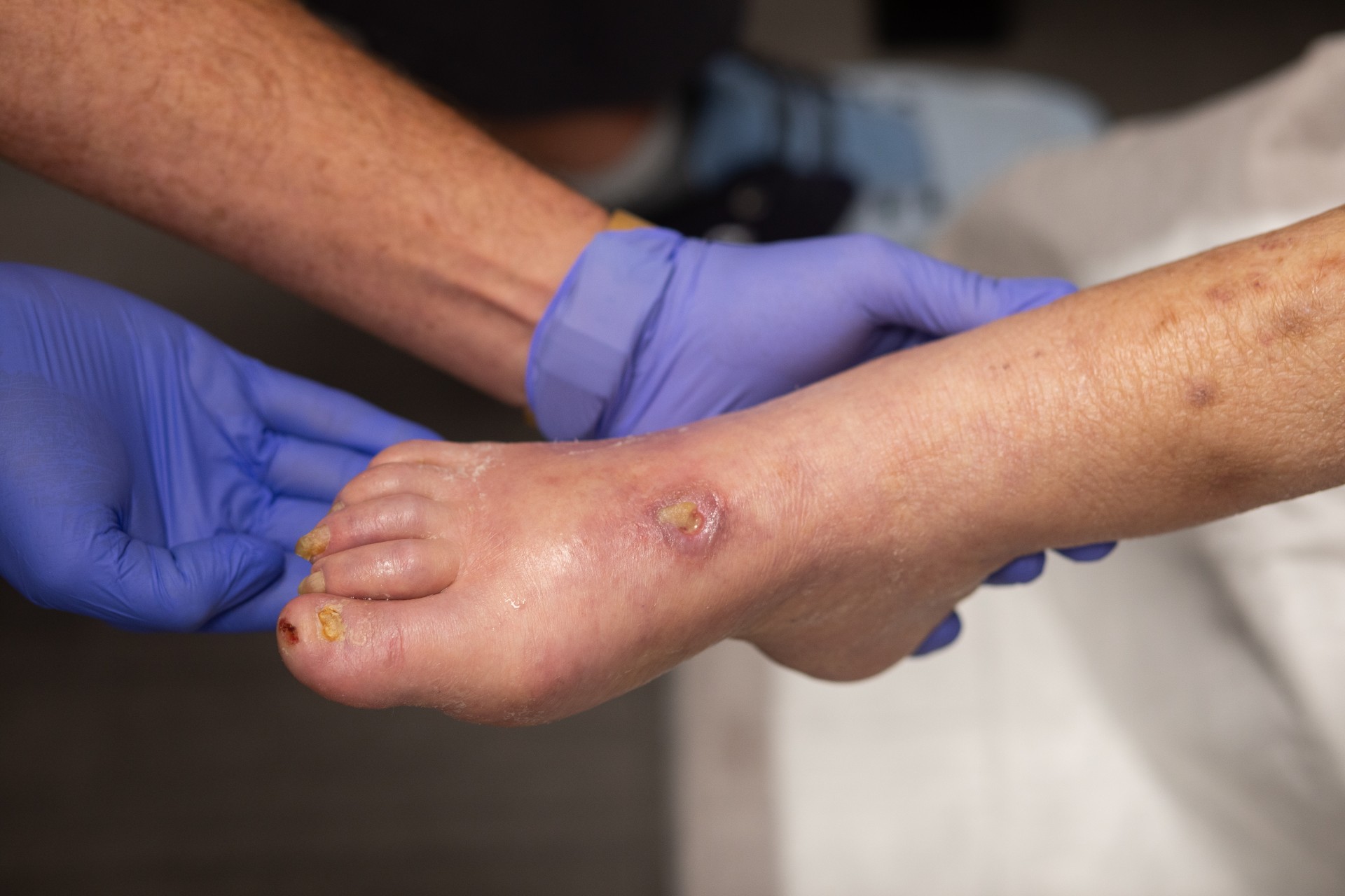 Circulation Related Wounds